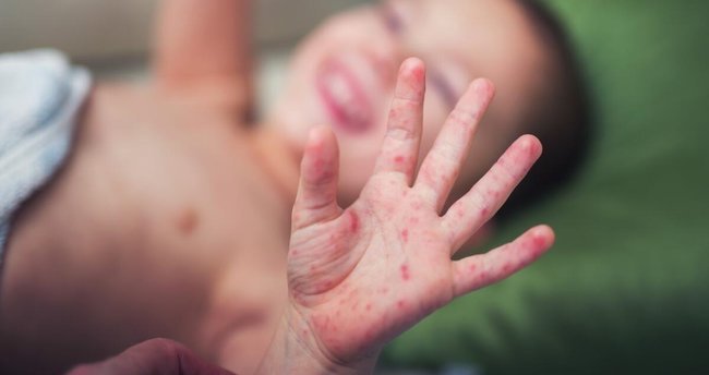 Bebek ve çocuklarda sık görülen el, ayak, ağız hastalığının solunum