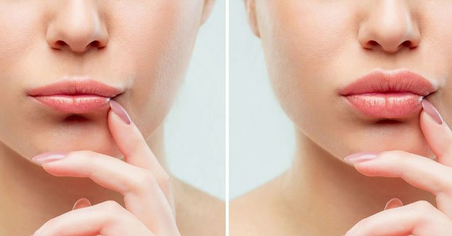 Medikal Estetik Hekimi Dr. Biran Ekici, konu hakkında bilgiler verdi.
İlk başta yapılmaması