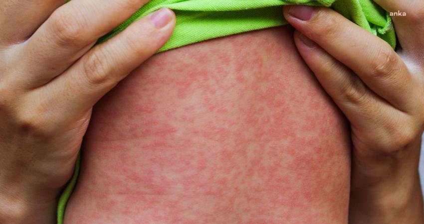 Sağlık Bakanlığı, 81 il valiliğine, kızamık vakalarının artması üzerine gerekli