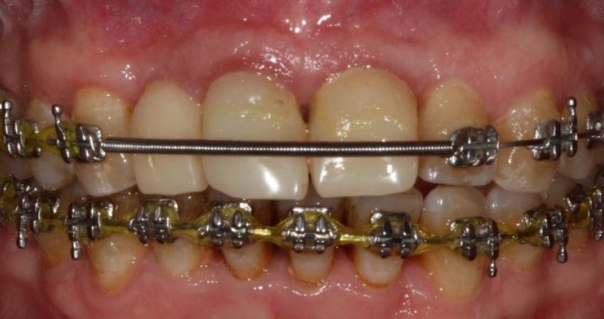 Dişeti hastalığı varlığında ortodontik tedaviye başlayacak hastaların dikkat etmesi gerekenleri