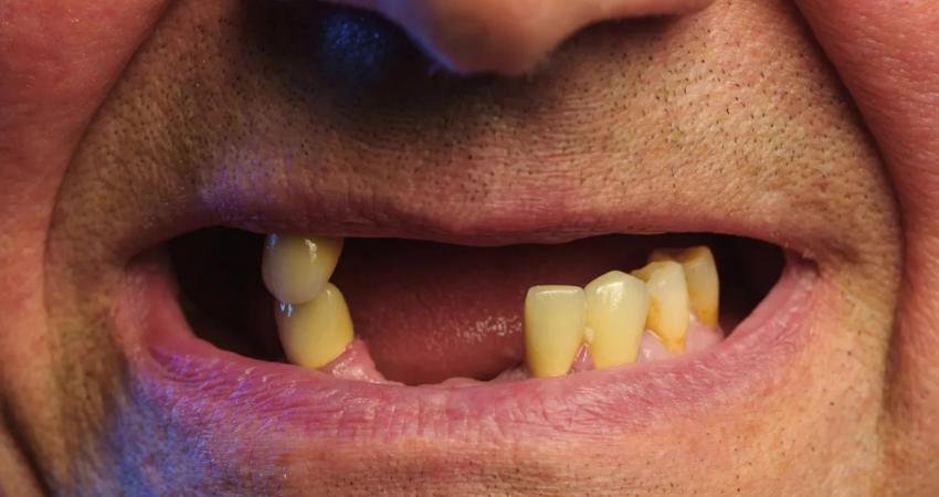 Japon bilim insanları, insanların dökülen dişlerini tekrar çıkarmalarını sağlayan sıra