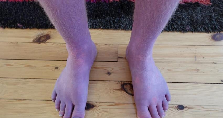 Doktorlar, bir süre ayakta durduğunda ayak ve bacakları mora dönüşen