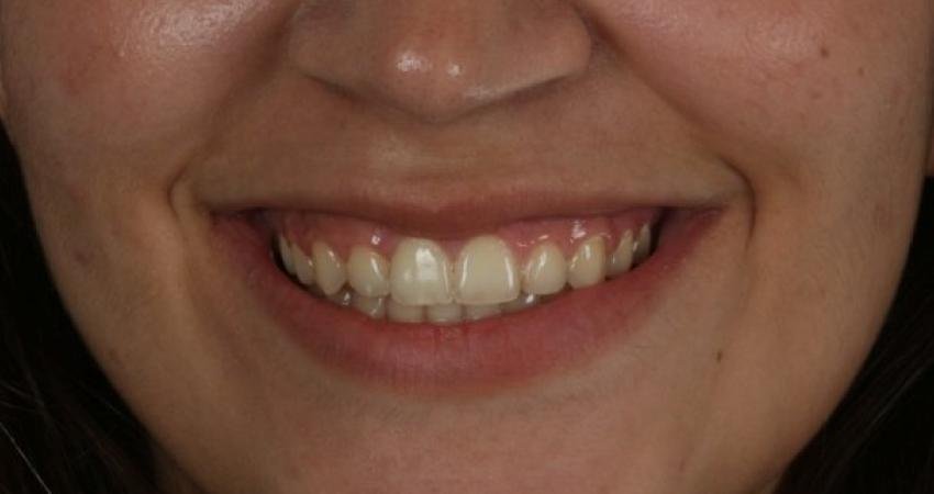 Ortodontik tedavi sonrasında dişlerinizde bir ölçü sallanma olabilir. Lakin bu