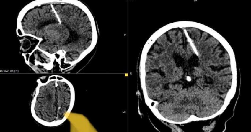 80 yaşındaki kadın, tüm ömrünü beynine saplanmış bir İğneyle geçirdi