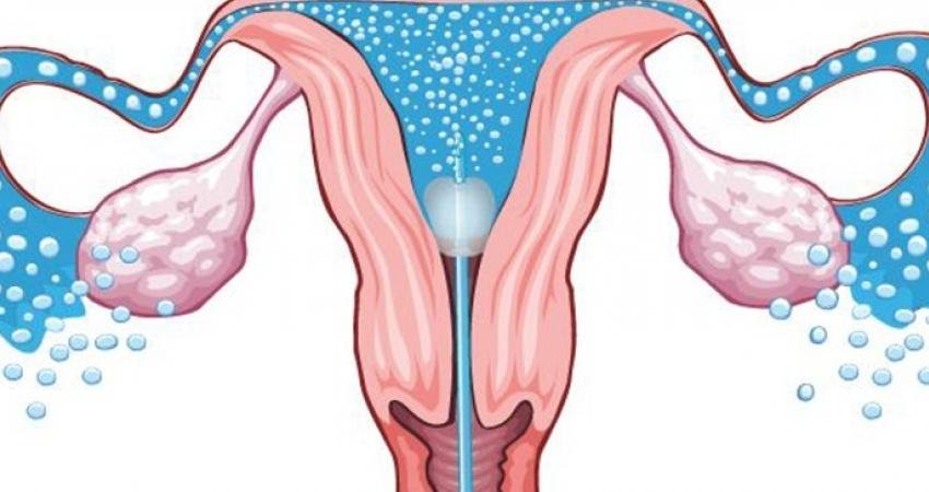 Rahim filmi, rahim ve fallop tüplerinin röntgen yöntemiyle görüntülenmesi işlemine