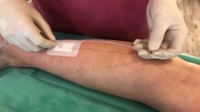 Almanya'nın Rostock şehrinde Dr. Ulf Thorsten Zierau, varisli damar hastalıklarının