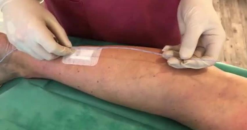 Türk bilim insanlarının katkısıyla Almanya’da güvenli varis tedavisi Almanya'nın Rostock şehrinde Dr. Ulf Thorsten Zierau, varisli damar hastalıklarının