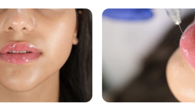 Dudak dolgusu fiyatları, estetik uygulamalar arasında en çok araştırılan konuların