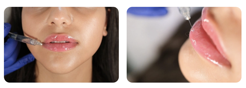 Dudak dolgusu ücretleri ne kadar? Kliniklere göre fiyat karşılaştırması Dudak dolgusu fiyatları, estetik uygulamalar arasında en çok araştırılan konuların